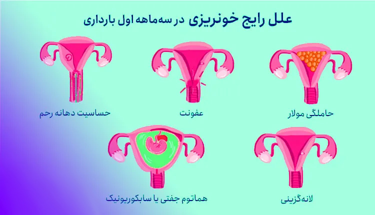 چه مقدار خونریزی در بارداری طبیعی است؟پریودی در بارداری