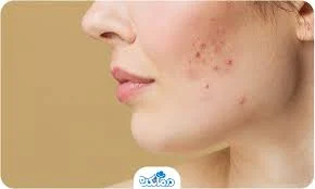 از بین بردن آکنه صورت